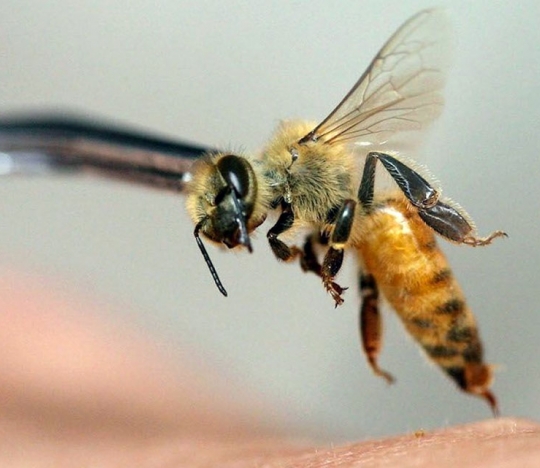 Лечение варикозной болезни пиявками и пчелами. Польза или вред?