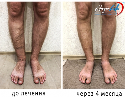 Эффективное лечение варикоза в Киеве | Опыт и качество