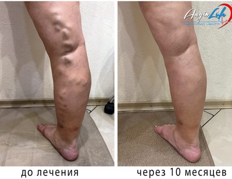 Ефективне лікування варикозу в Києві | Досвід та якість