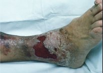 Varicose disease - what will happen if not treated?