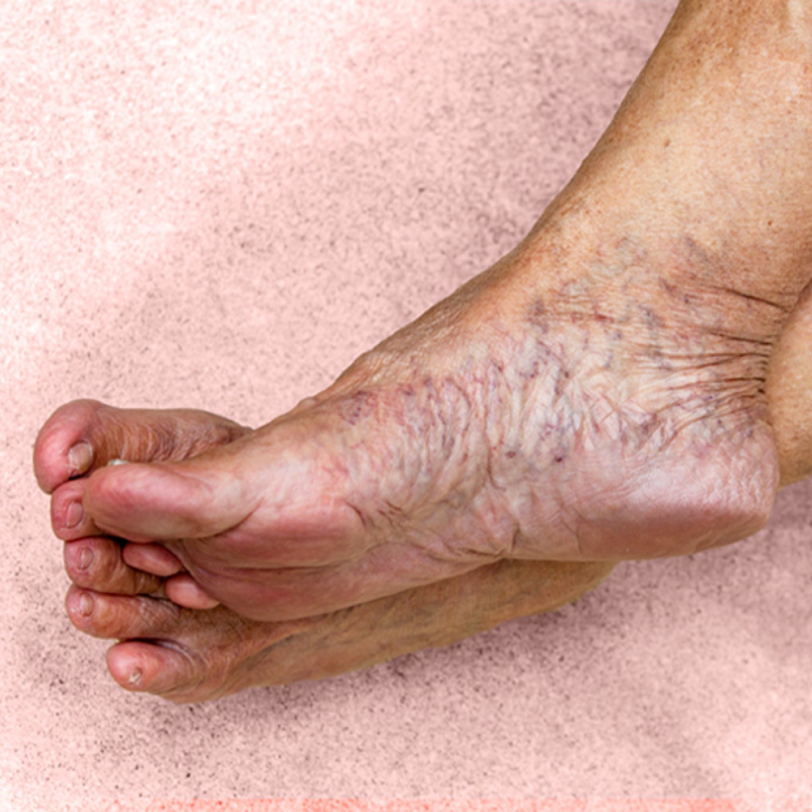 Treat varicose veins at home | Phlebologist's advice AngioLife