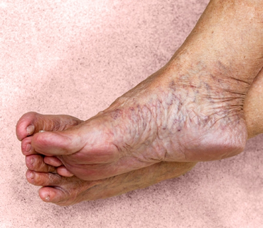 How to treat varicose veins at home?