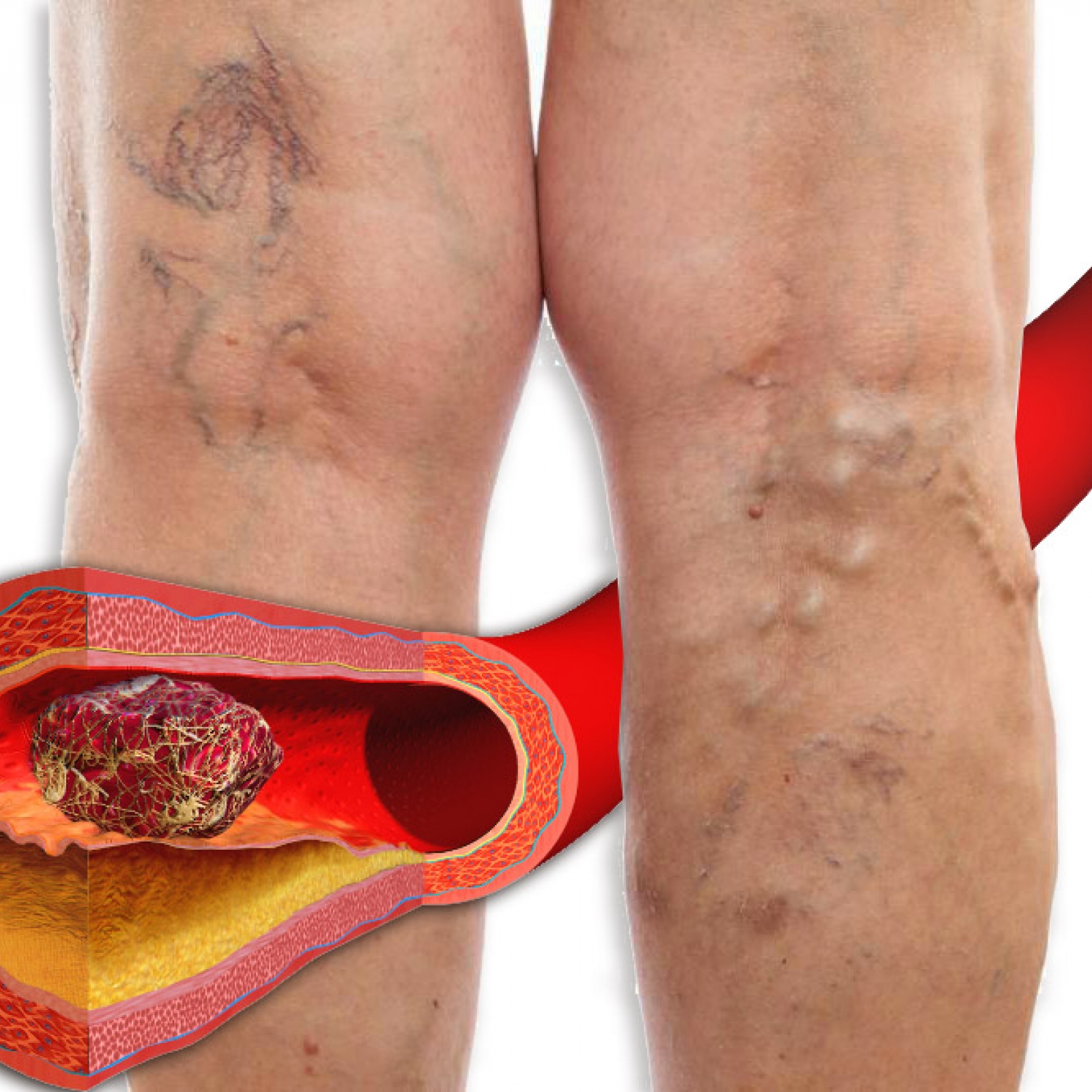 Why is varicose veins dangerous? | Vascular Center AngioLife®