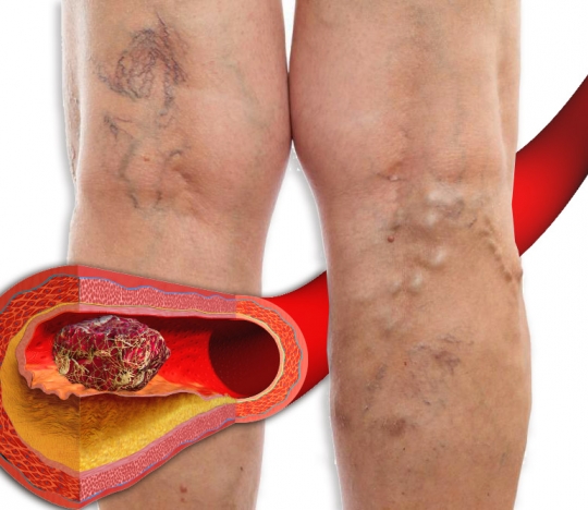 Why is varicose veins dangerous?