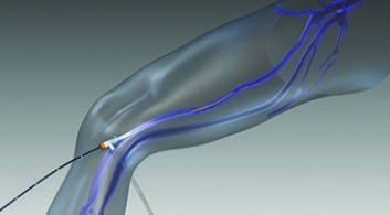 Radiofrequency ablation of varicose veins | AngioLife®