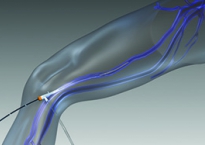 Radiofrequency ablation of varicose veins