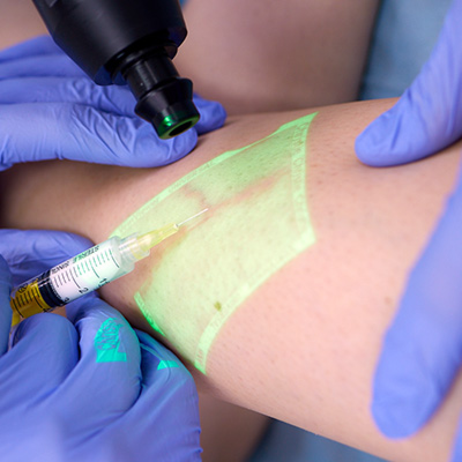 Microsclerotherapy in Kyiv and Zaporozhye | Results, reviews, price
