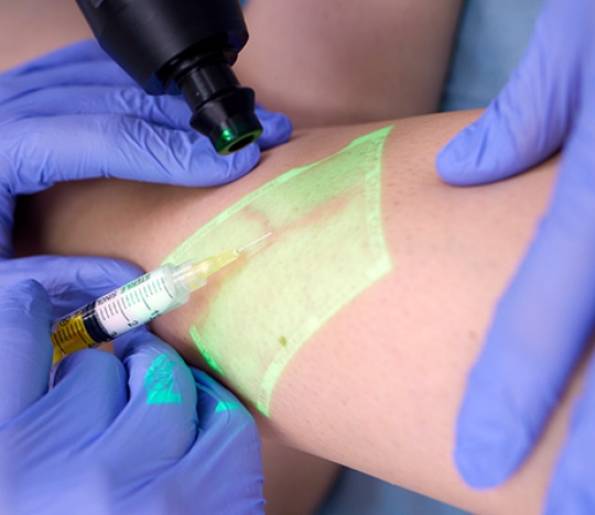 Microsclerotherapy