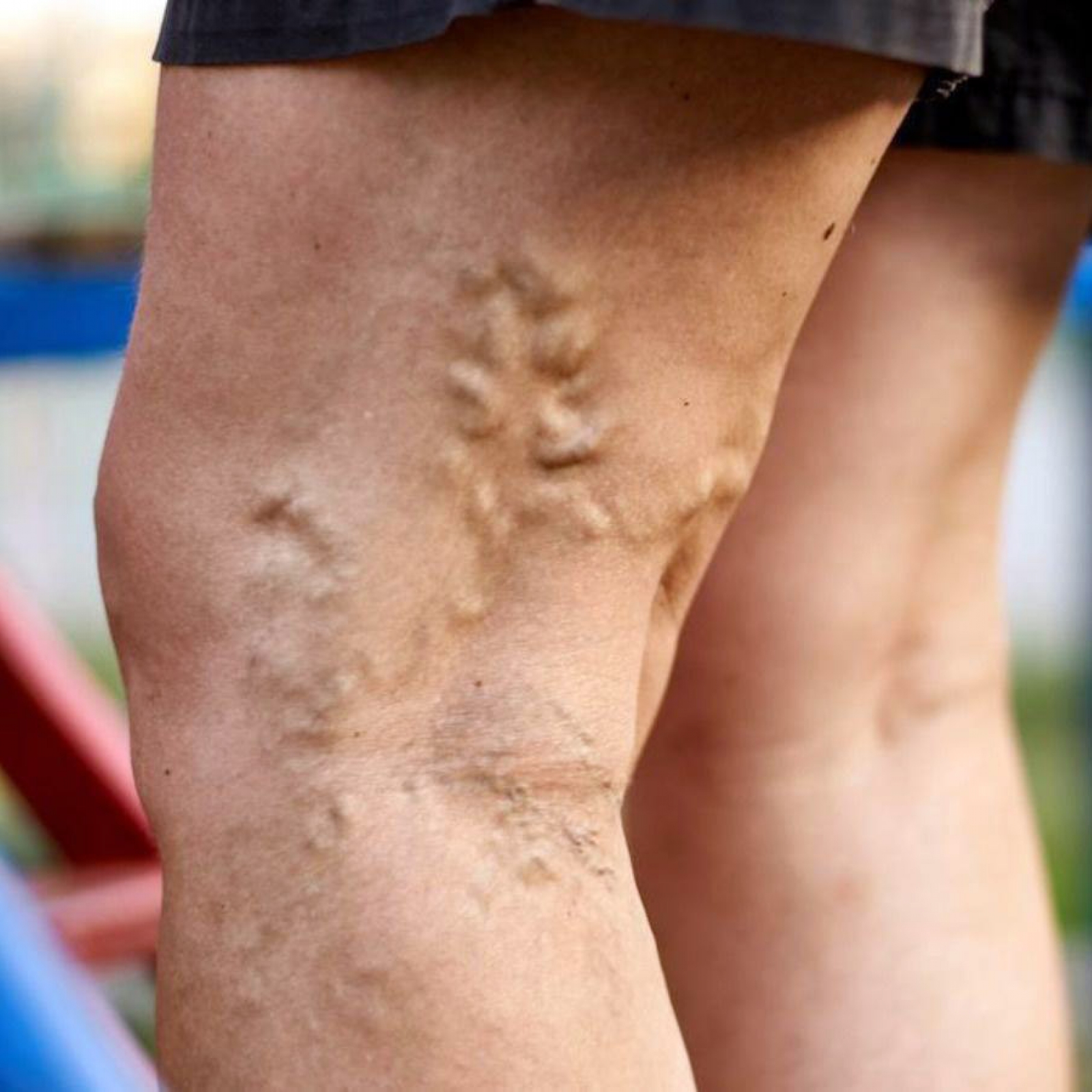 Varicose veins cause and risk factors | Symptoms of varicose veins | AngioLife®