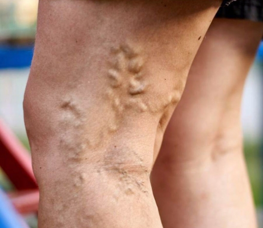 Causes and symptoms of varicose veins