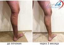 Treatment of varicose veins in spring