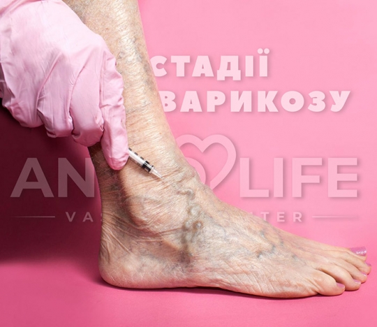 Stage of development of varicose veins