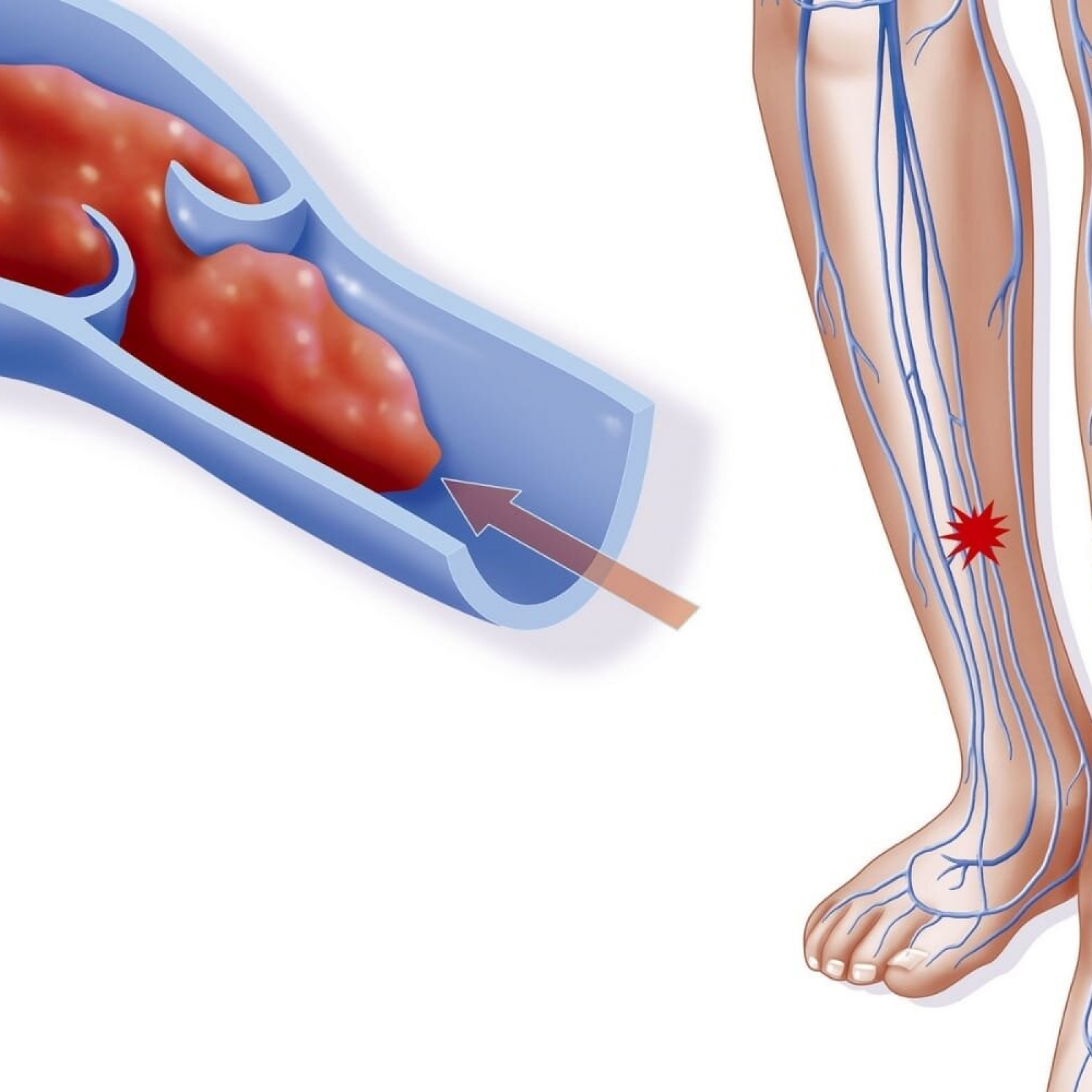 Is it possible to treat deep vein thrombosis without anticoagulant therapy?