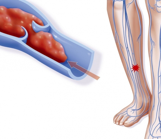 Is it possible to treat deep vein thrombosis without anticoagulant therapy?