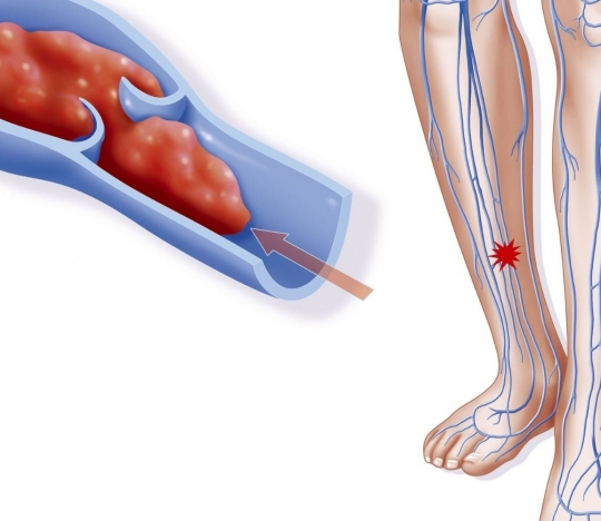 Чи можливо лікувати тромбоз глибоких вен без антикоагулянтної терапії?