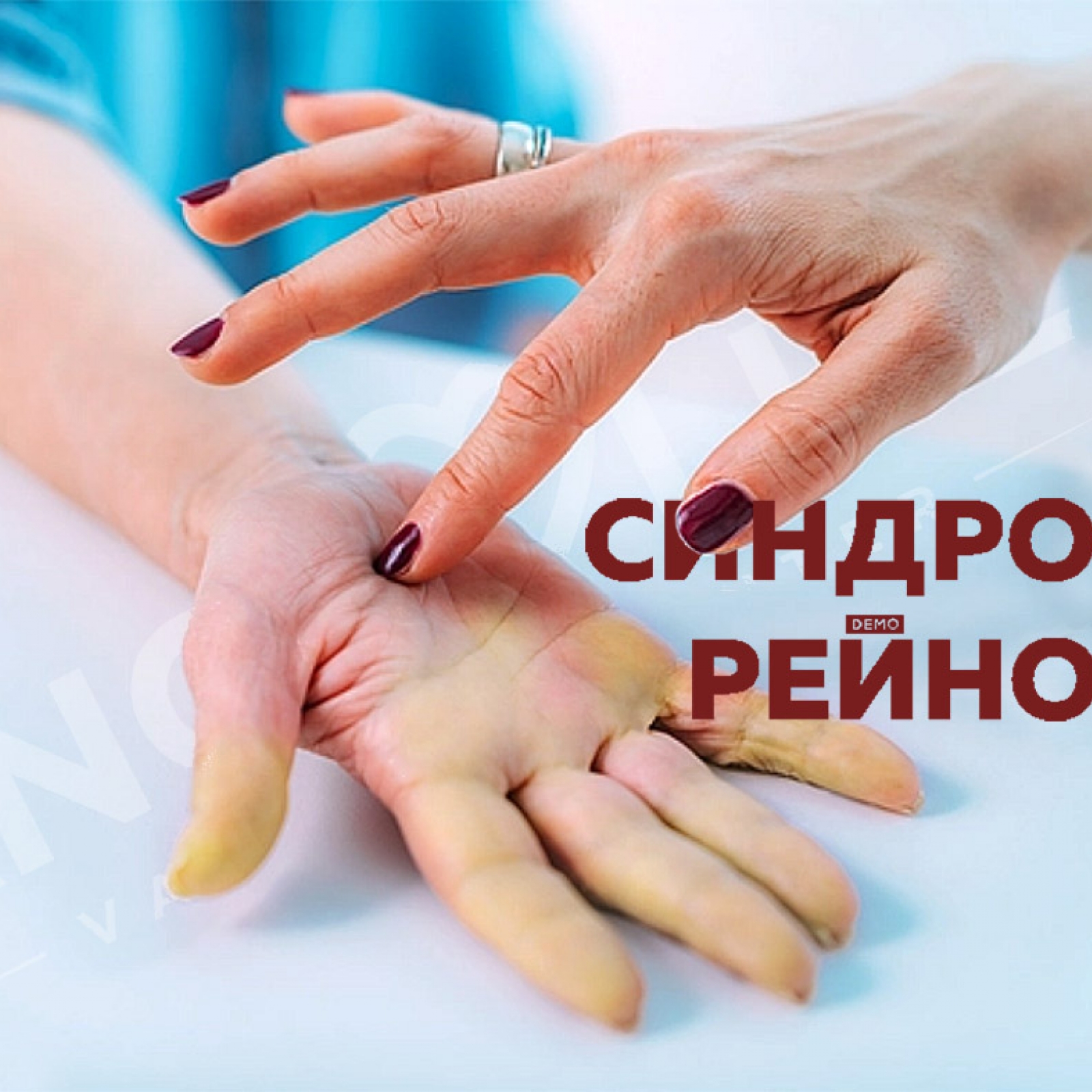 Raynaud's syndrome | Dangerous or not