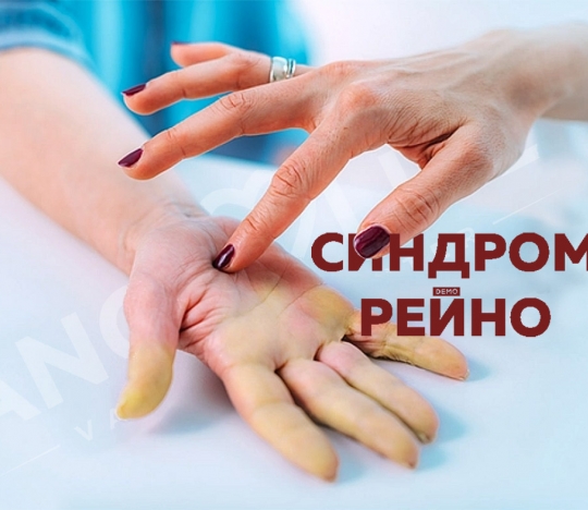 Raynaud's Syndrome