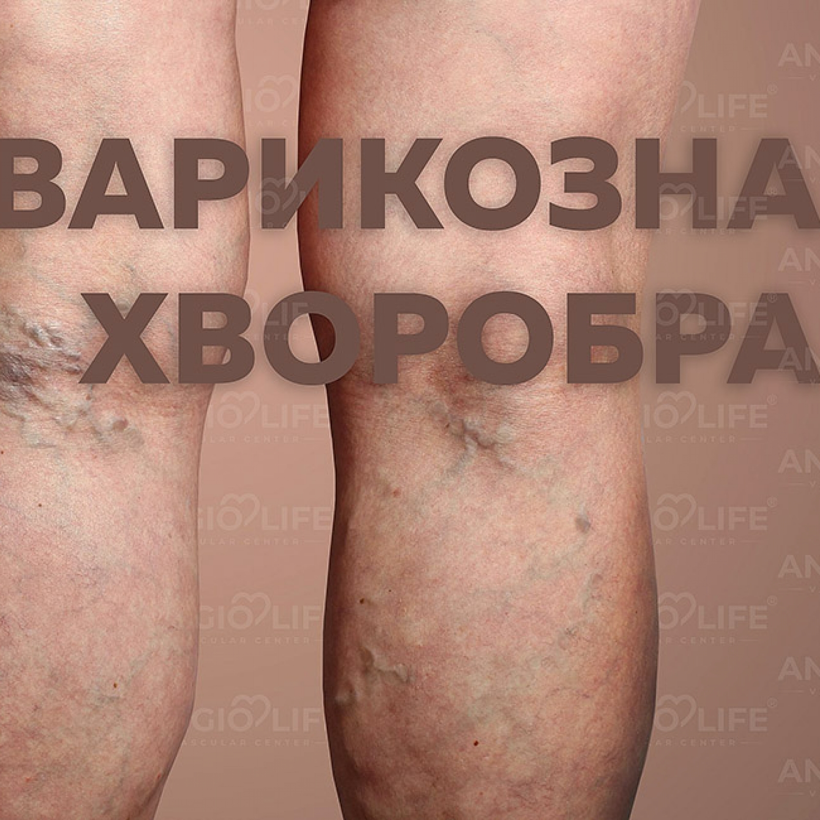 Varicose veins | Briefly about the main thing
