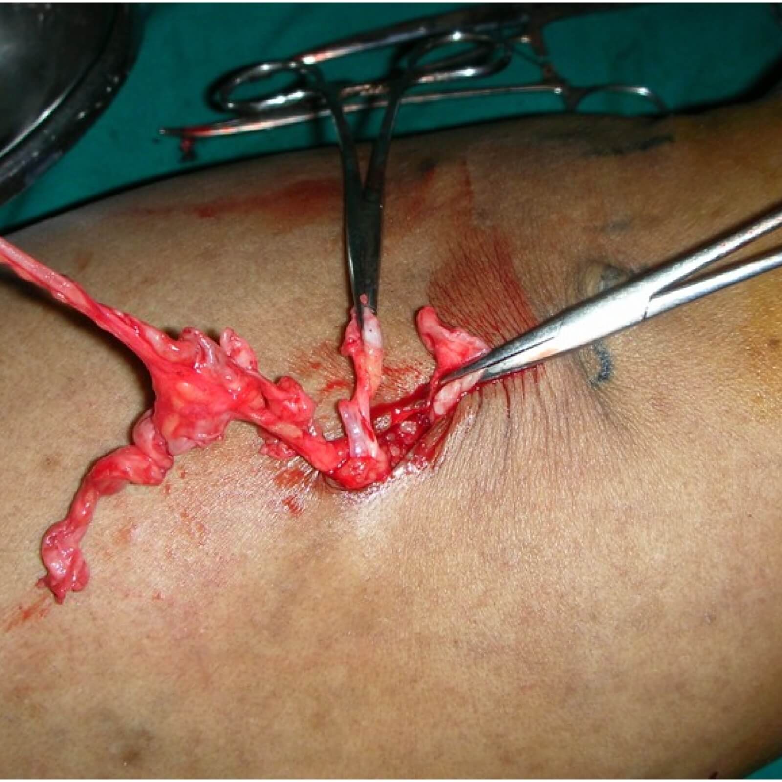 Phlebectomy, venectomy  How to remove varicose veins before