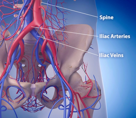 May-Thurner syndrome