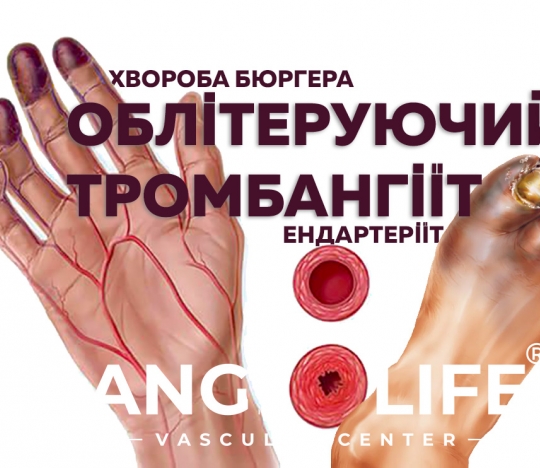 Thromboangiitis obliterans, Buerger's disease and Endarteritis
