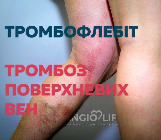 Thrombophlebitis and thrombosis of superficial veins