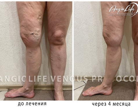 Effective treatment of varicose veins in Kyiv | Experience and quality