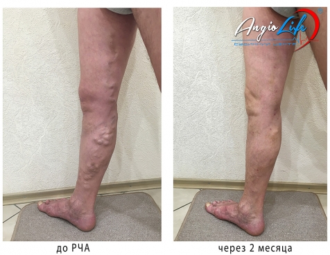 Effective treatment of varicose veins in Kyiv | Experience and quality
