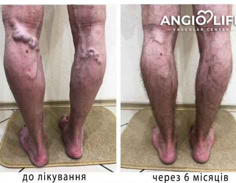 Effective treatment of varicose veins in Kyiv | Experience and quality