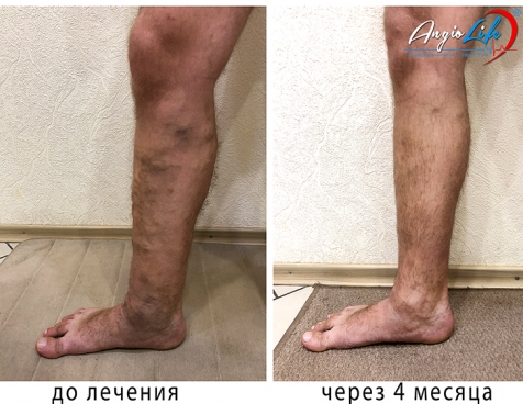 Effective treatment of varicose veins in Kyiv | Experience and quality