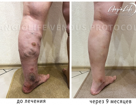 Effective treatment of varicose veins in Kyiv | Experience and quality