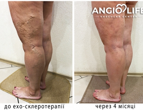 Varicose veins treatment Zaporizhzhia NO surgery | AngioLife®