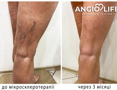 Varicose veins treatment Zaporizhzhia NO surgery | AngioLife®
