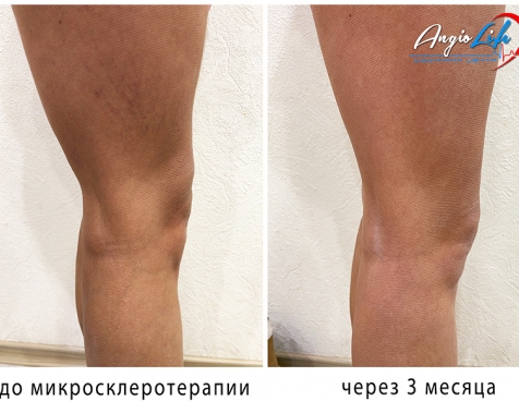 Varicose veins treatment Zaporizhzhia NO surgery | AngioLife®