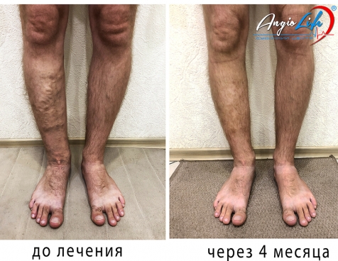 Varicose veins treatment Zaporizhzhia NO surgery | AngioLife®