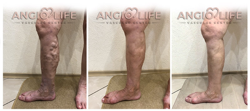 Фото варикоз, лімфостаз до та після лікування АнгіоЛайф