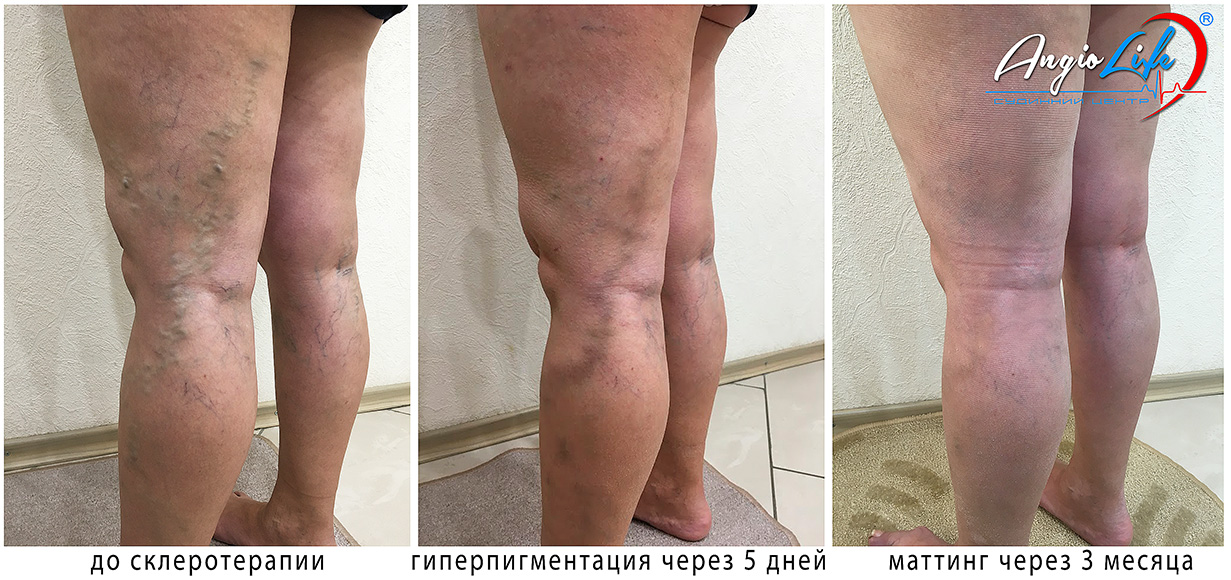 какие могут быть последствия после склеротерапии. Смотреть фото какие могут быть последствия после склеротерапии. Смотреть картинку какие могут быть последствия после склеротерапии. Картинка про какие могут быть последствия после склеротерапии. Фото какие могут быть последствия после склеротерапии