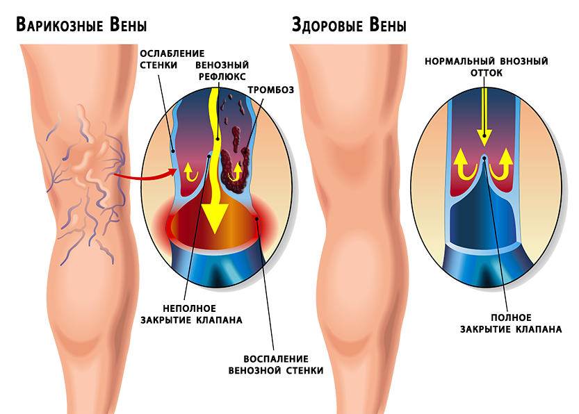 варикоз