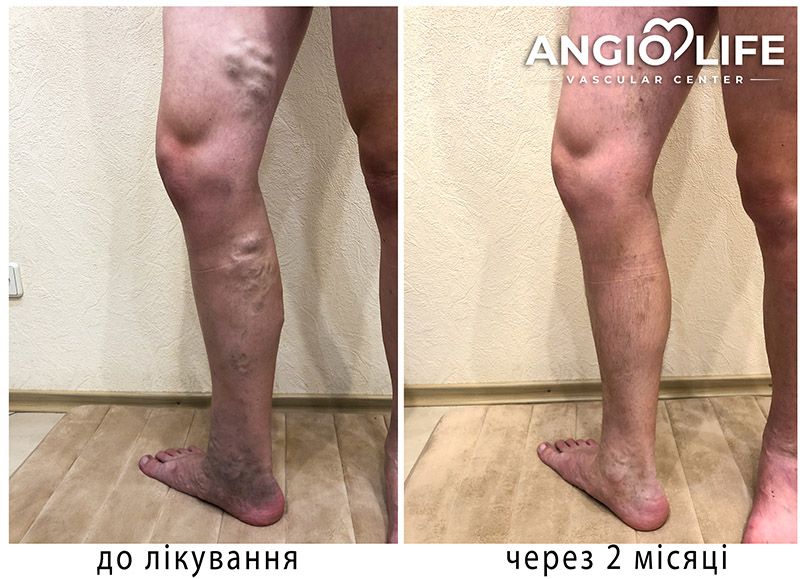 ANGIOLIFE_Варикоз_индурація