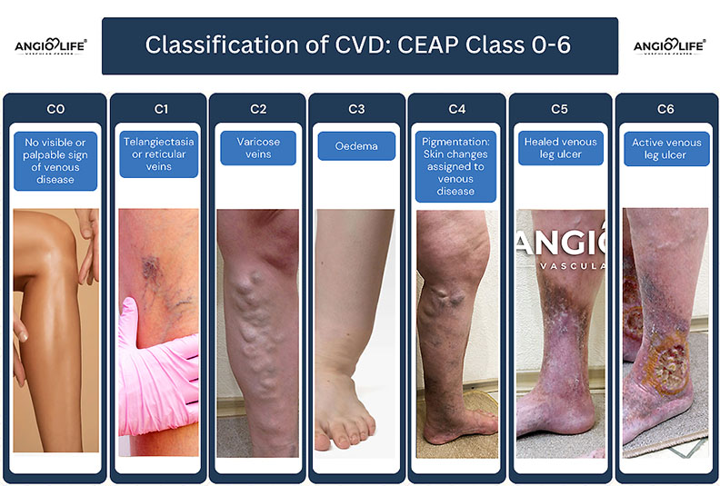 CEAP_VARICOSE_VEINS