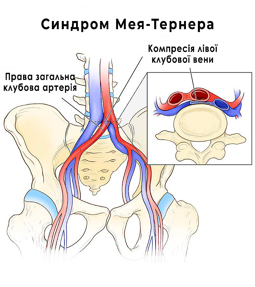 May-Thurner syndrome