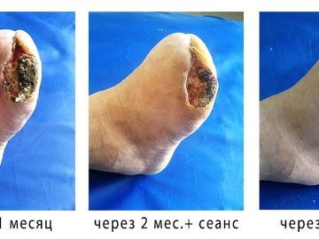 Angiolife лечение трофических язв