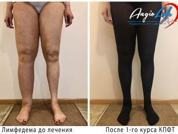 Lymphedema