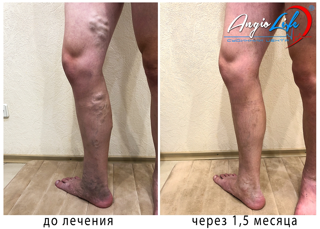 Лечение варикоза биоклеем в Киеве и Запорожье – цена в АнгиоЛайф®