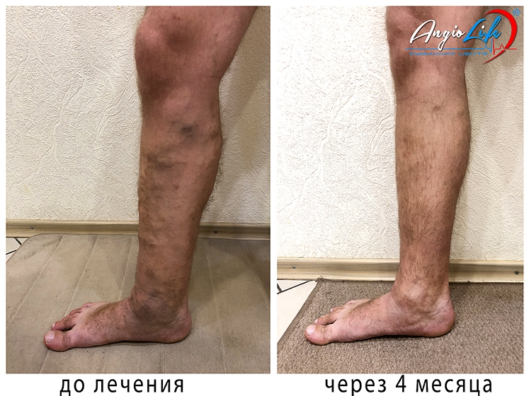 Эффективное лечение варикоза лазером в Киеве и Запорожье