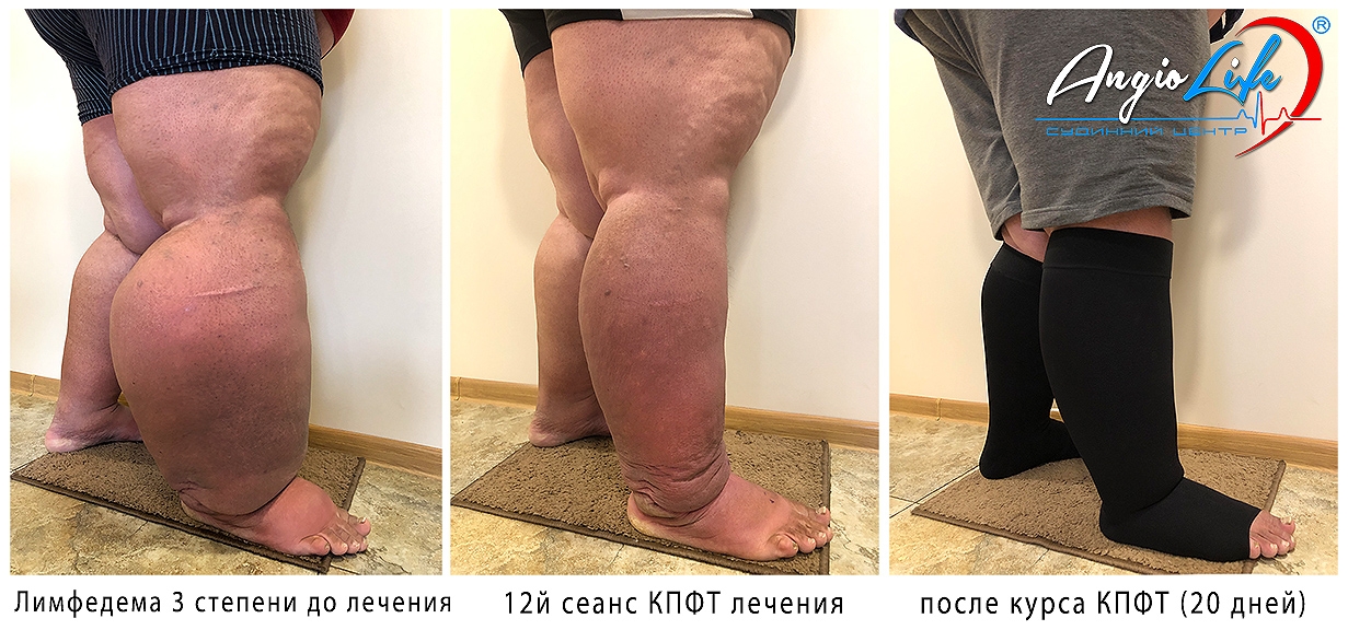 Комплексна протинабрякова терапія – ціна на КФПТ Київ, Запоріжжя