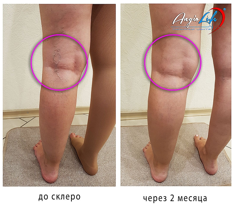Склеротерапия в Киеве и Запорожье – цена в "АнгиоЛайф®"